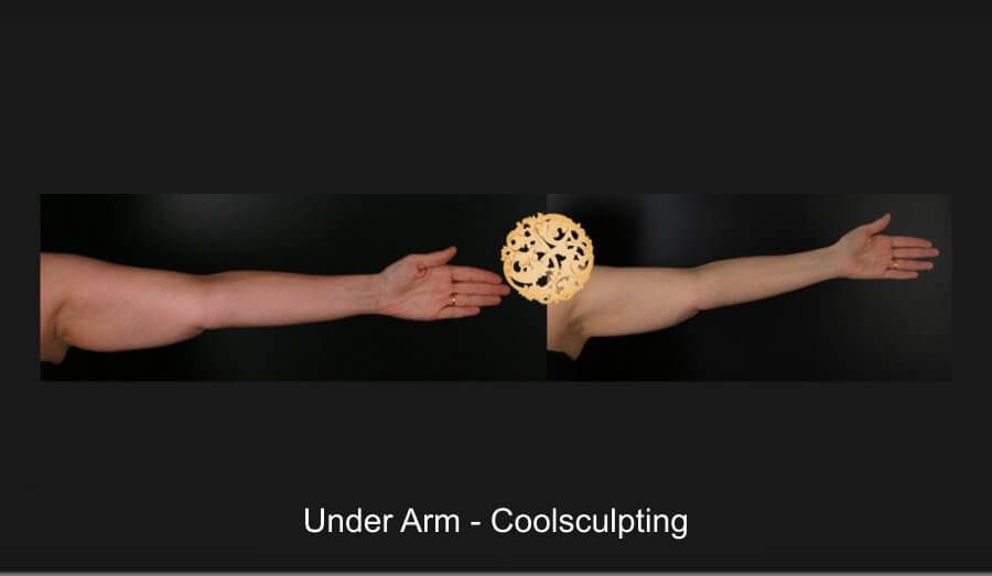 Coolsculpting Arms Before & After