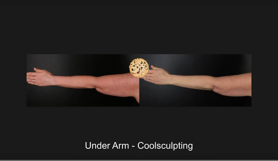 Coolsculpting Arms Before & After