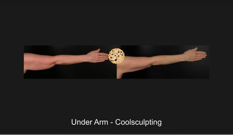 Coolsculpting Arms Before & After
