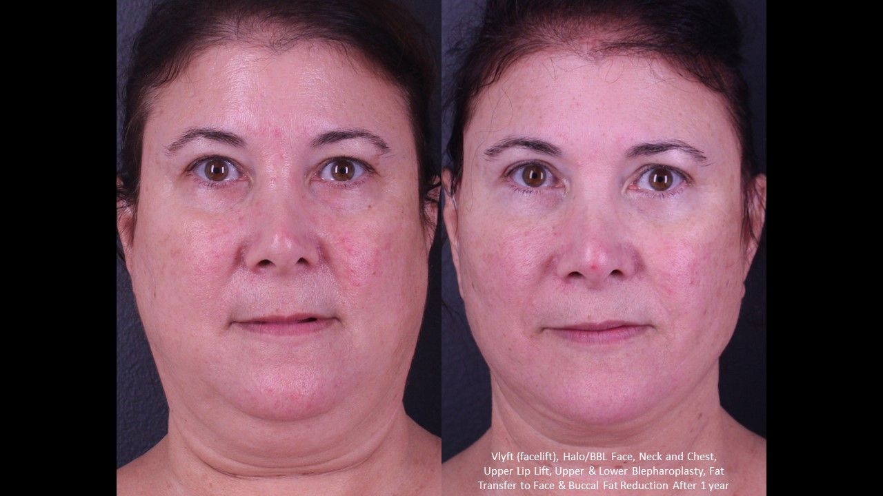 Lower Blepharoplasty Before & After