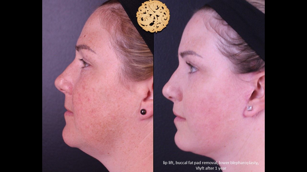 Lower Blepharoplasty Before & After