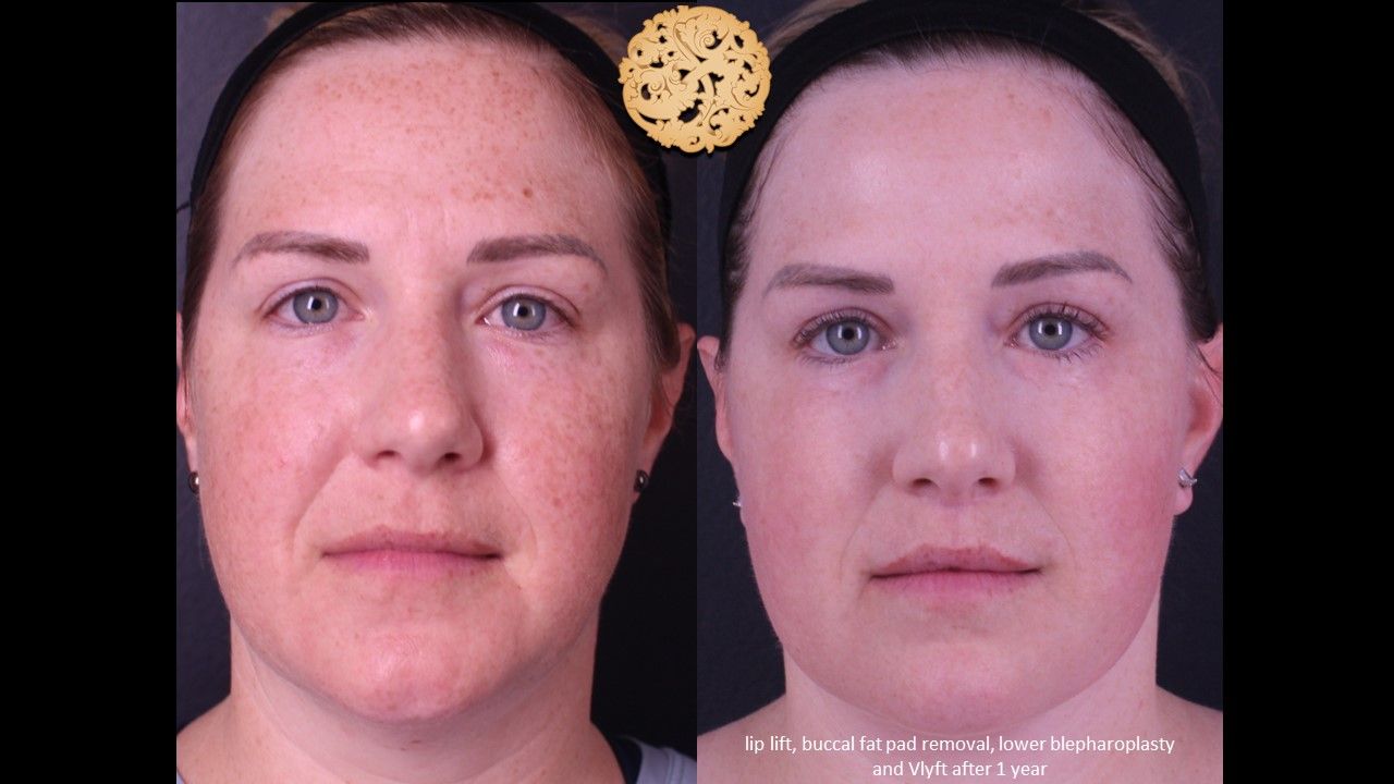 Lower Blepharoplasty Before & After