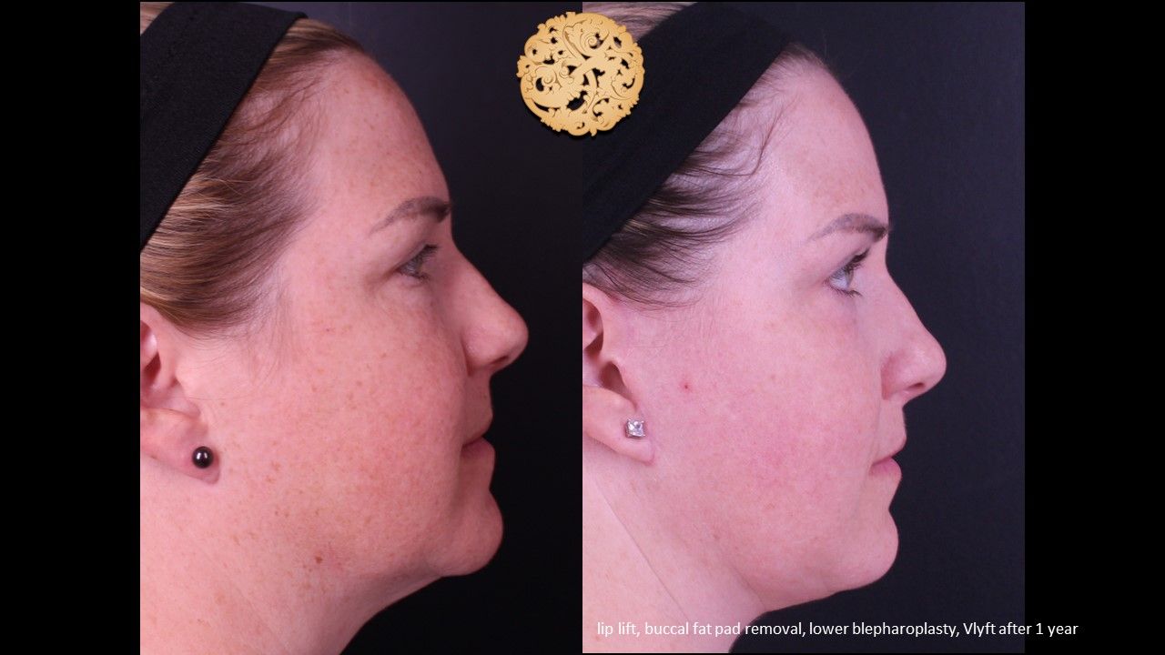 Lower Blepharoplasty Before & After