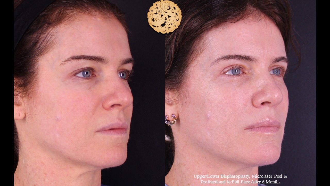 Lower Blepharoplasty Before & After