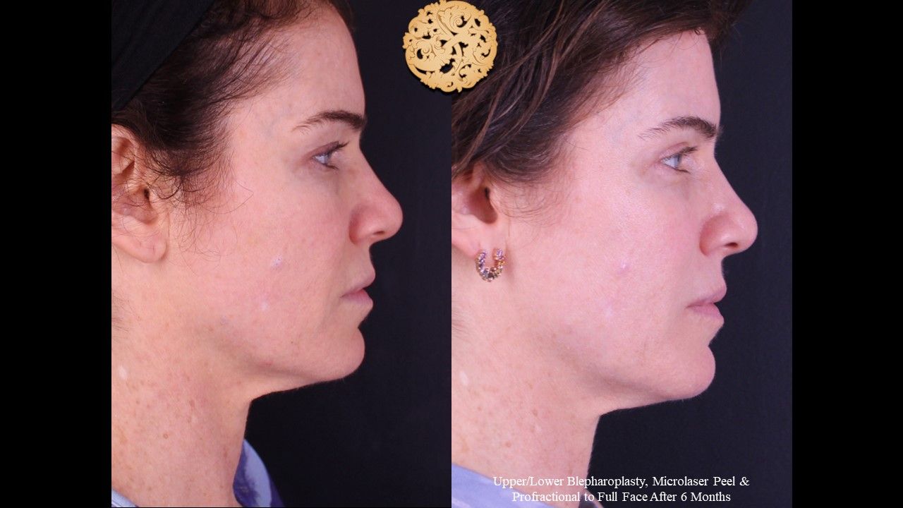 Lower Blepharoplasty Before & After