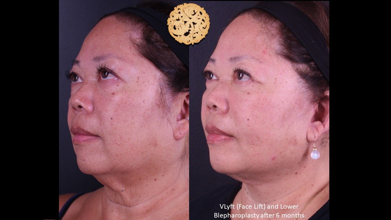 Lower Blepharoplasty Before & After