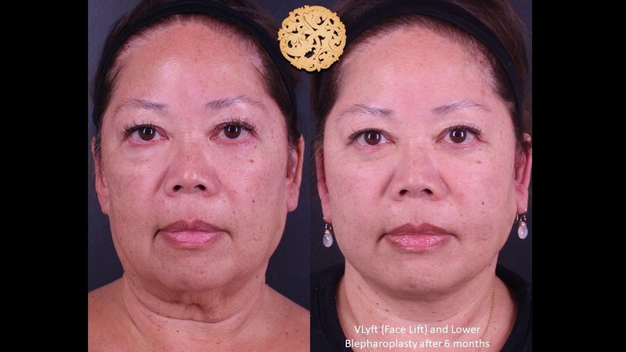 Lower Blepharoplasty Before & After