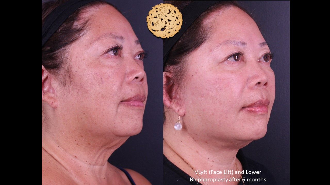 Lower Blepharoplasty Before & After