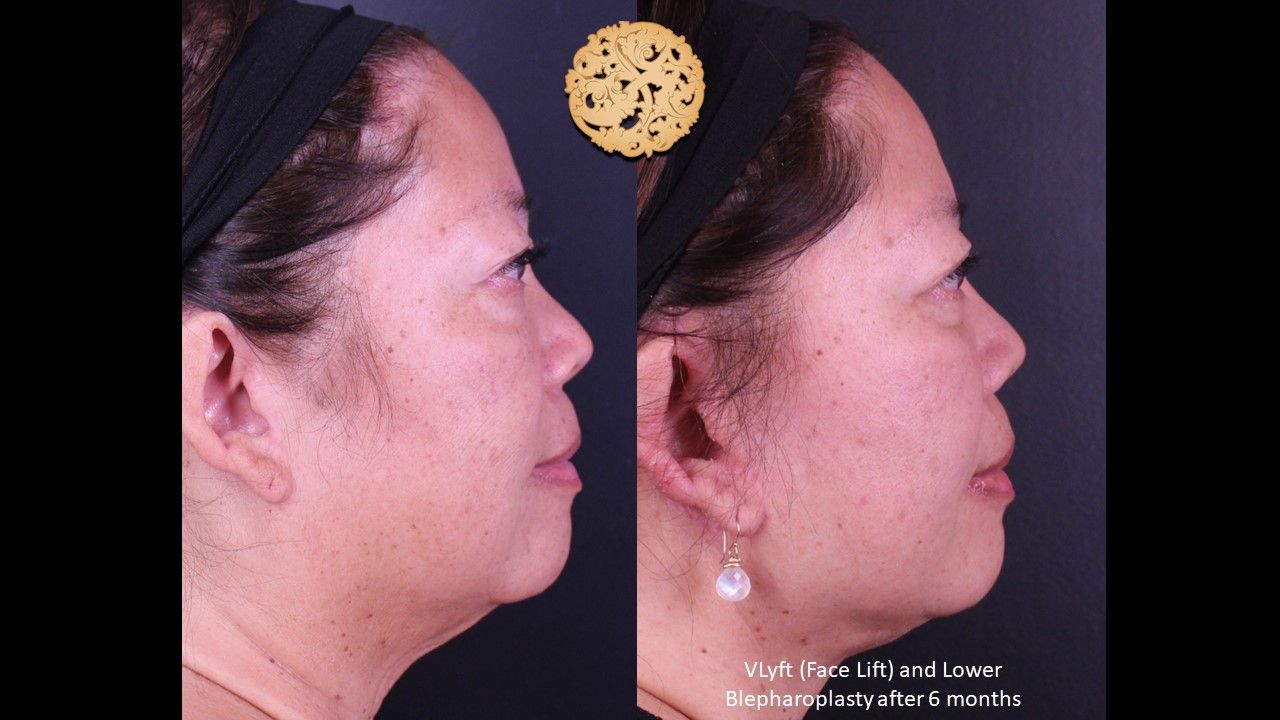 Lower Blepharoplasty Before & After