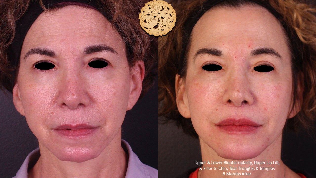 Lower Blepharoplasty Before & After