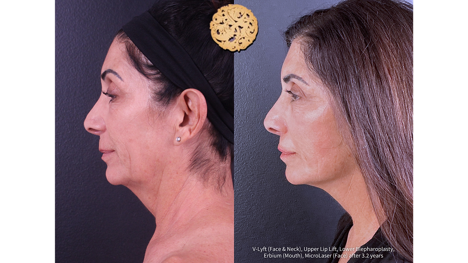 Lower Blepharoplasty Before and After