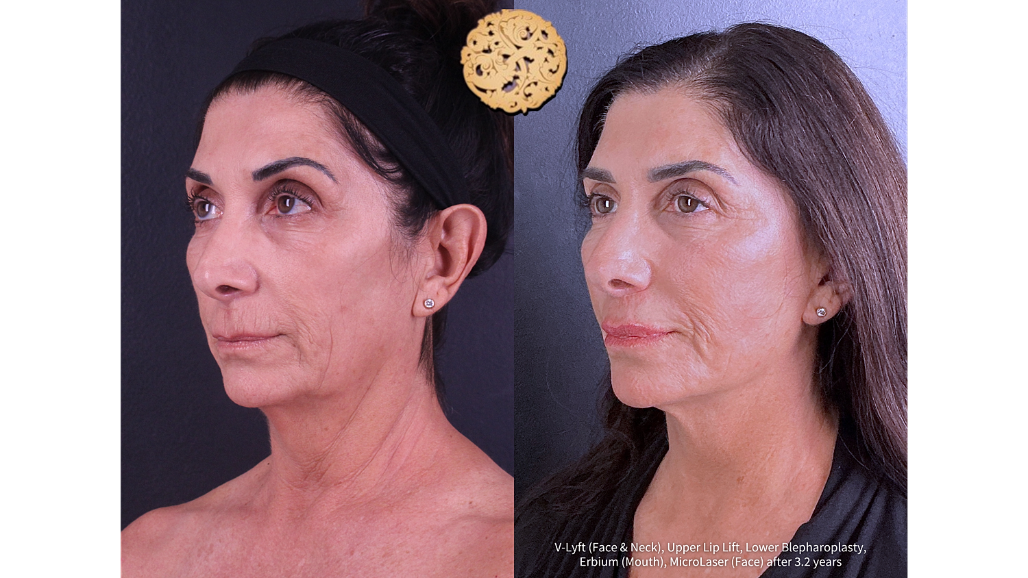 Lower Blepharoplasty Before and After