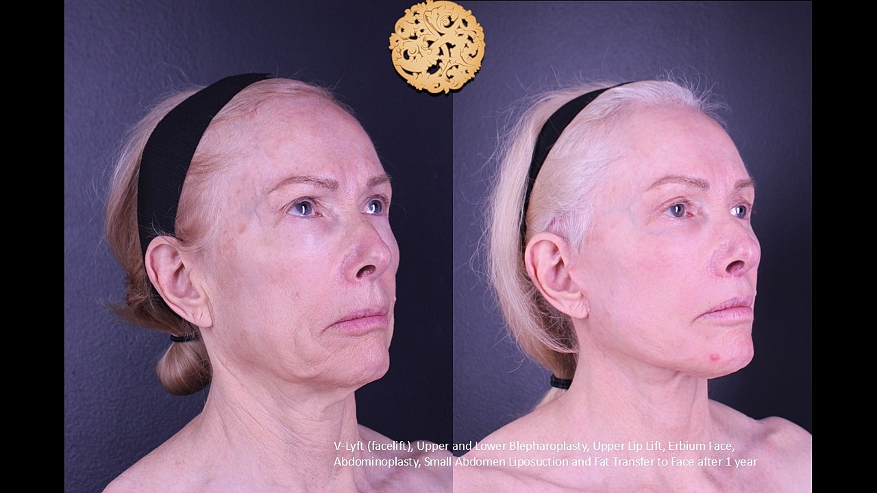 Lower Blepharoplasty Before & After