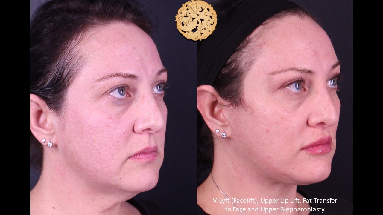 Brow Lift Before & After