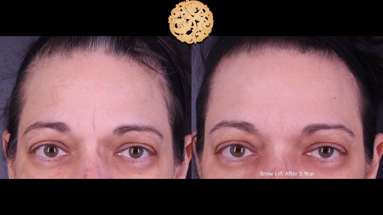 Brow Lift Before & After