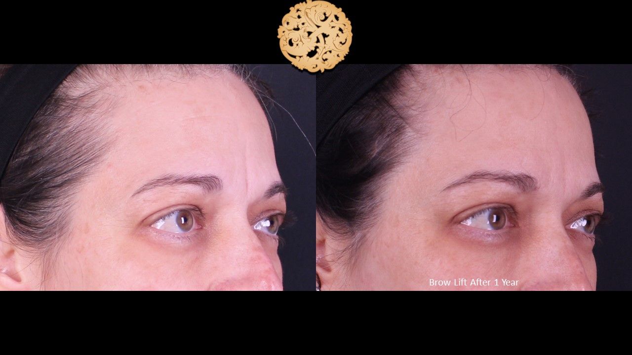 Brow Lift Before & After