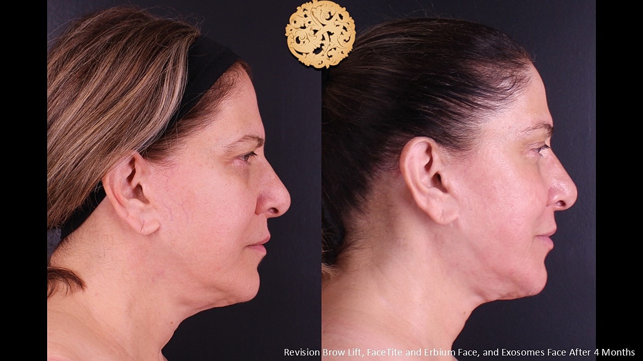 Brow Lift Before & After