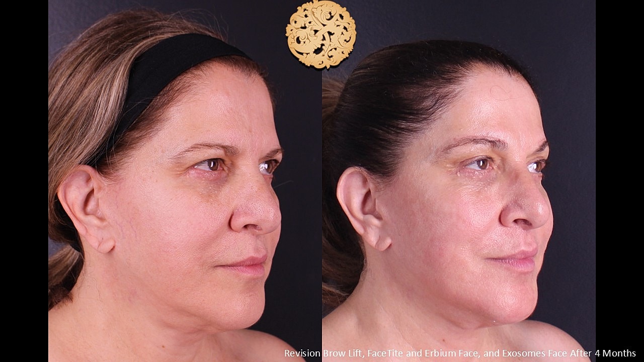 Brow Lift Before & After