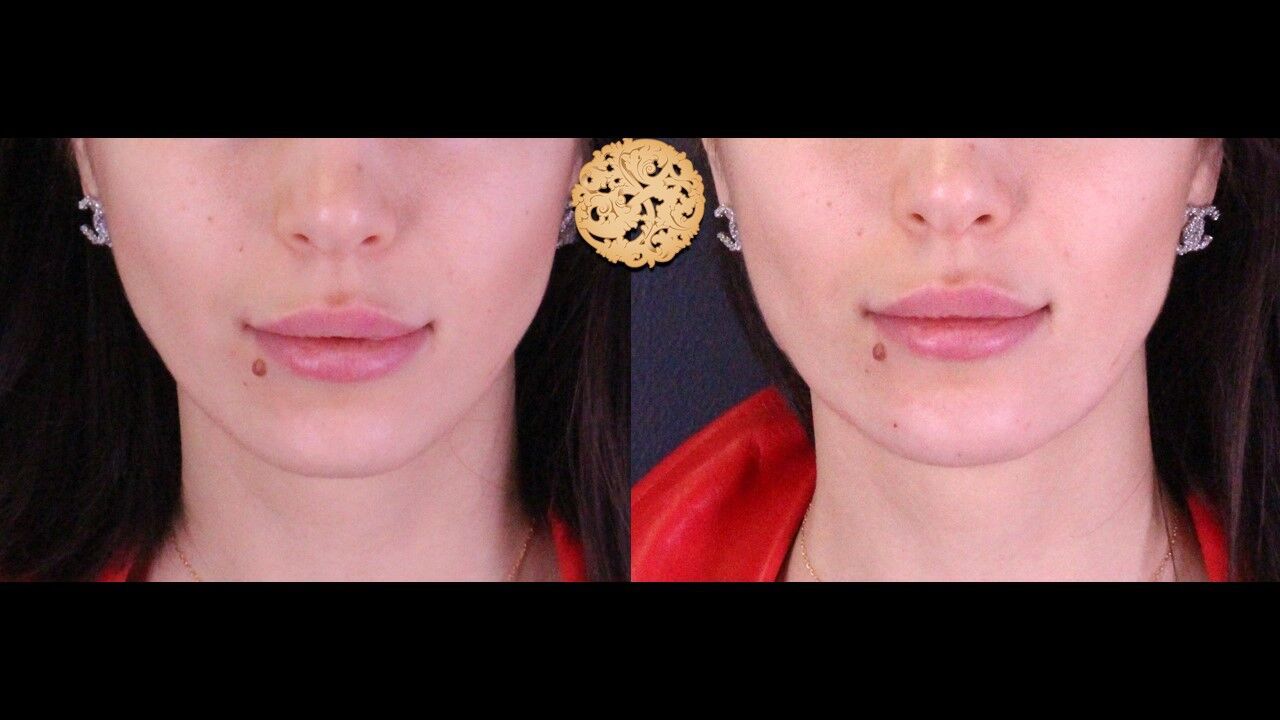Jaw Filler Before & After