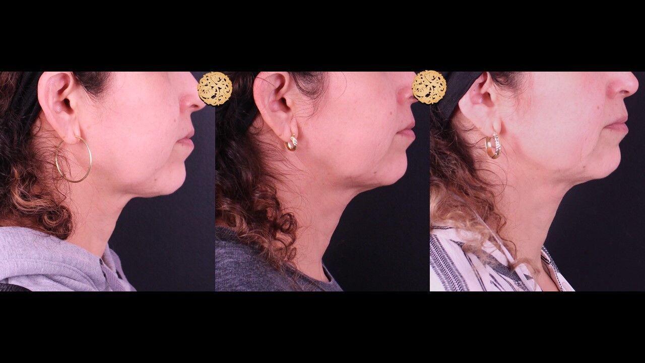 Jaw Filler Before & After