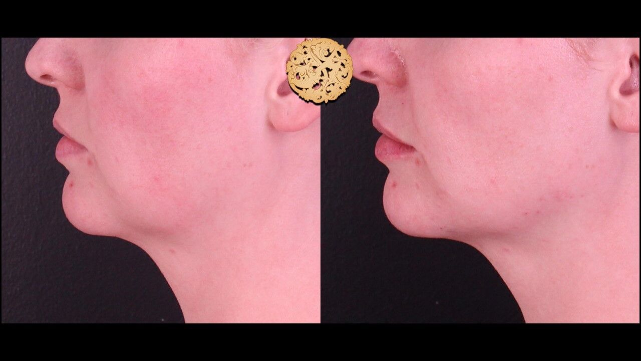 Jaw Filler Before & After
