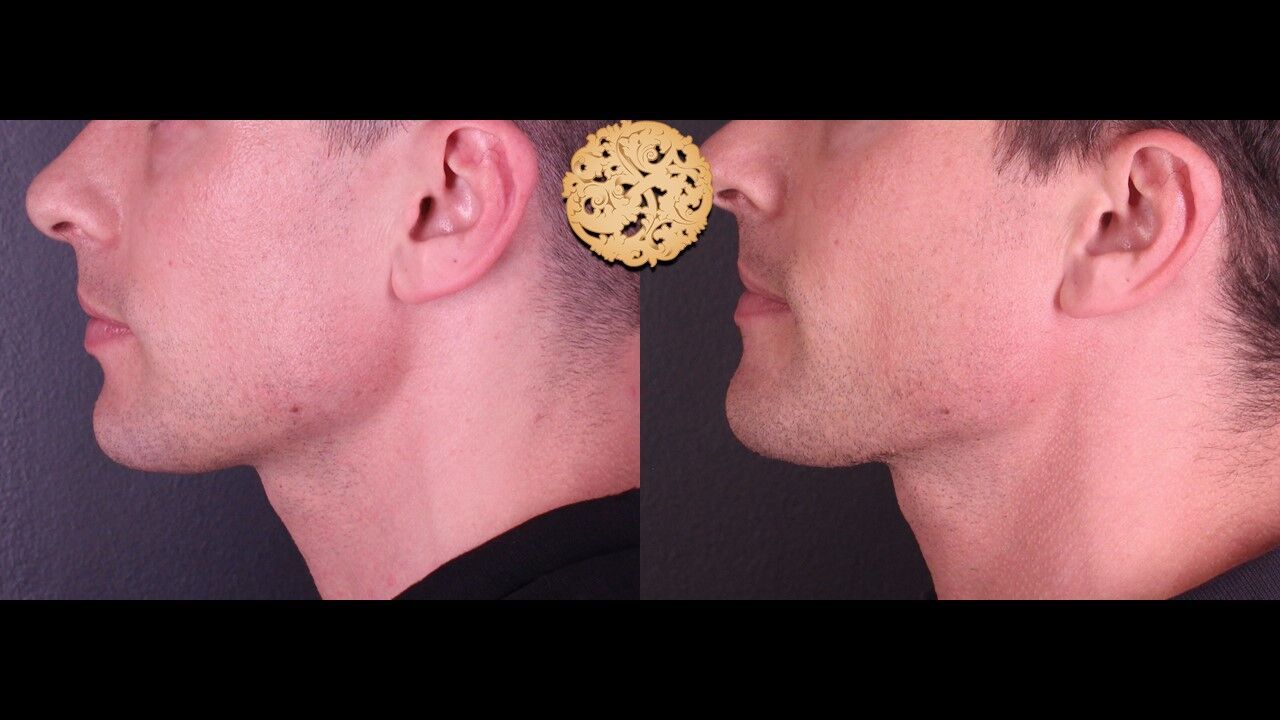 Jaw Filler Before & After