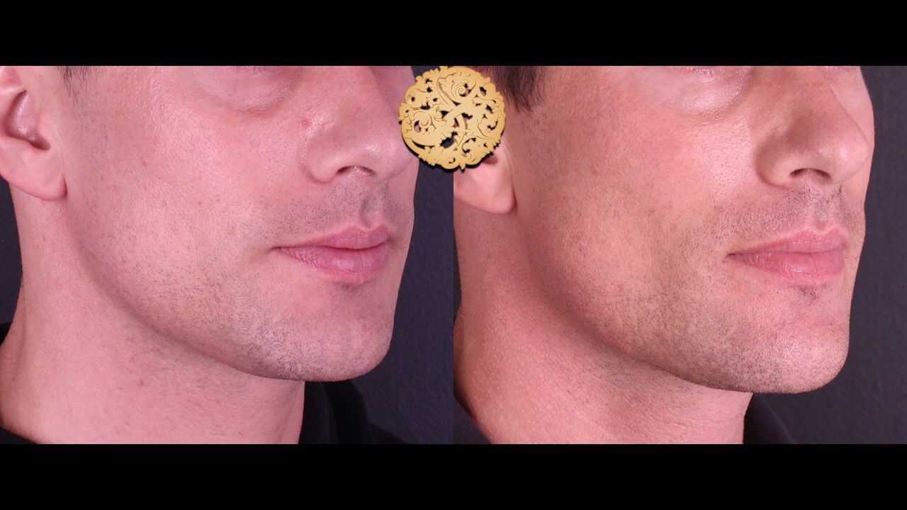 Jaw Filler Before & After