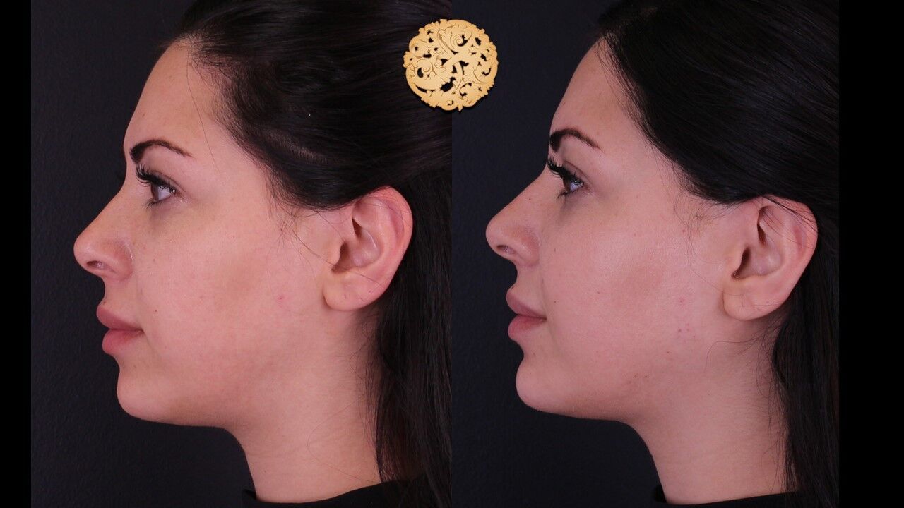 Jaw Filler Before & After
