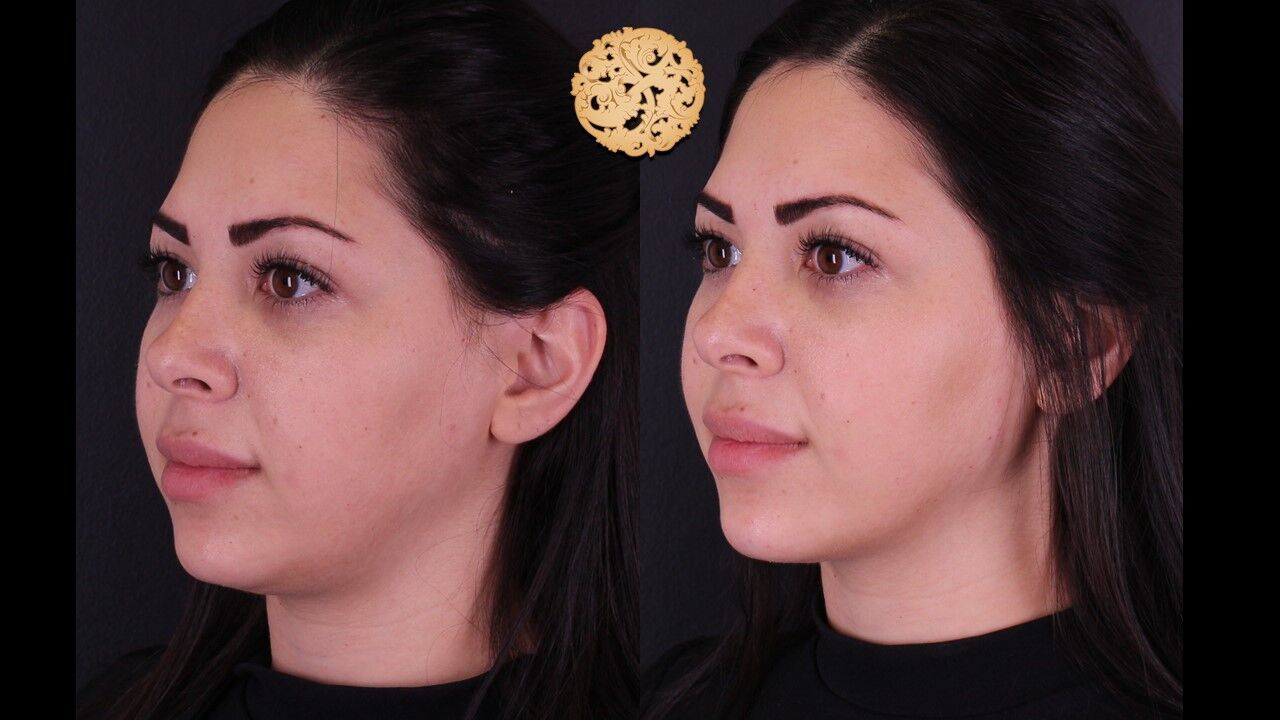 Jaw Filler Before & After