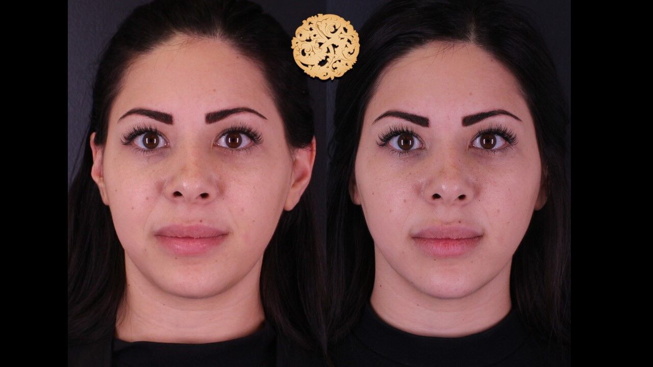 Jaw Filler Before & After