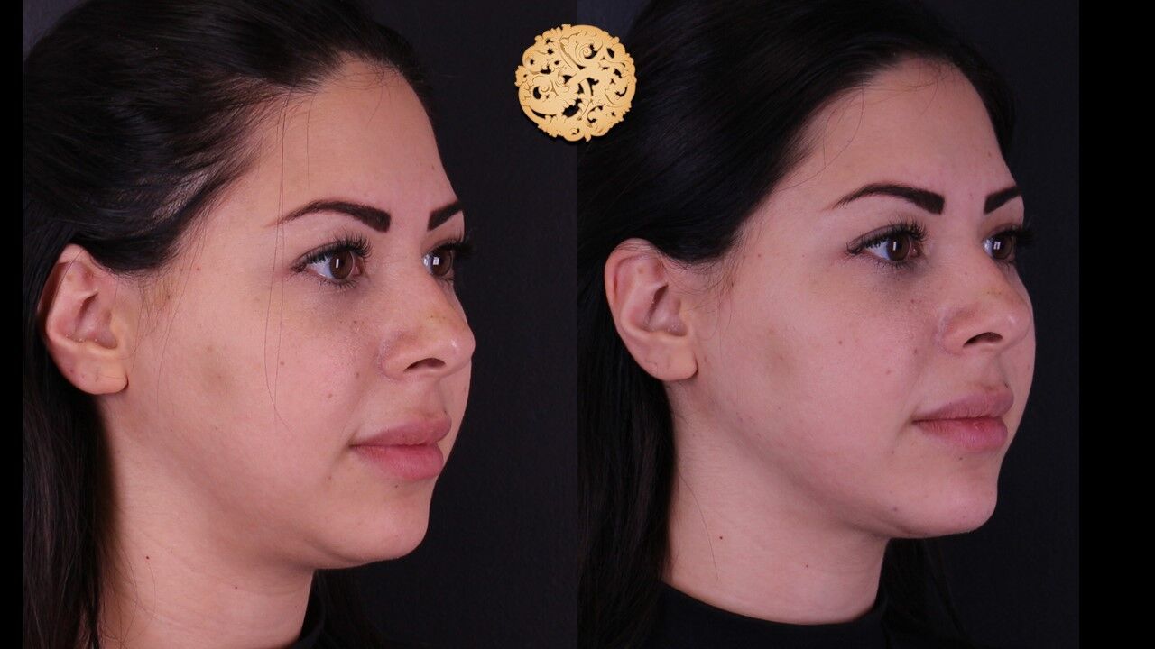 Jaw Filler Before & After