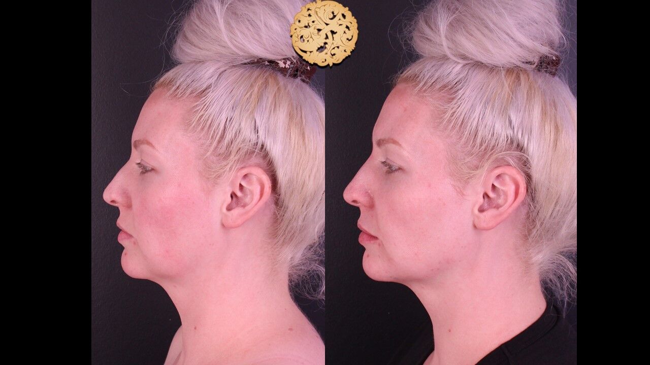 Jaw Filler Before & After