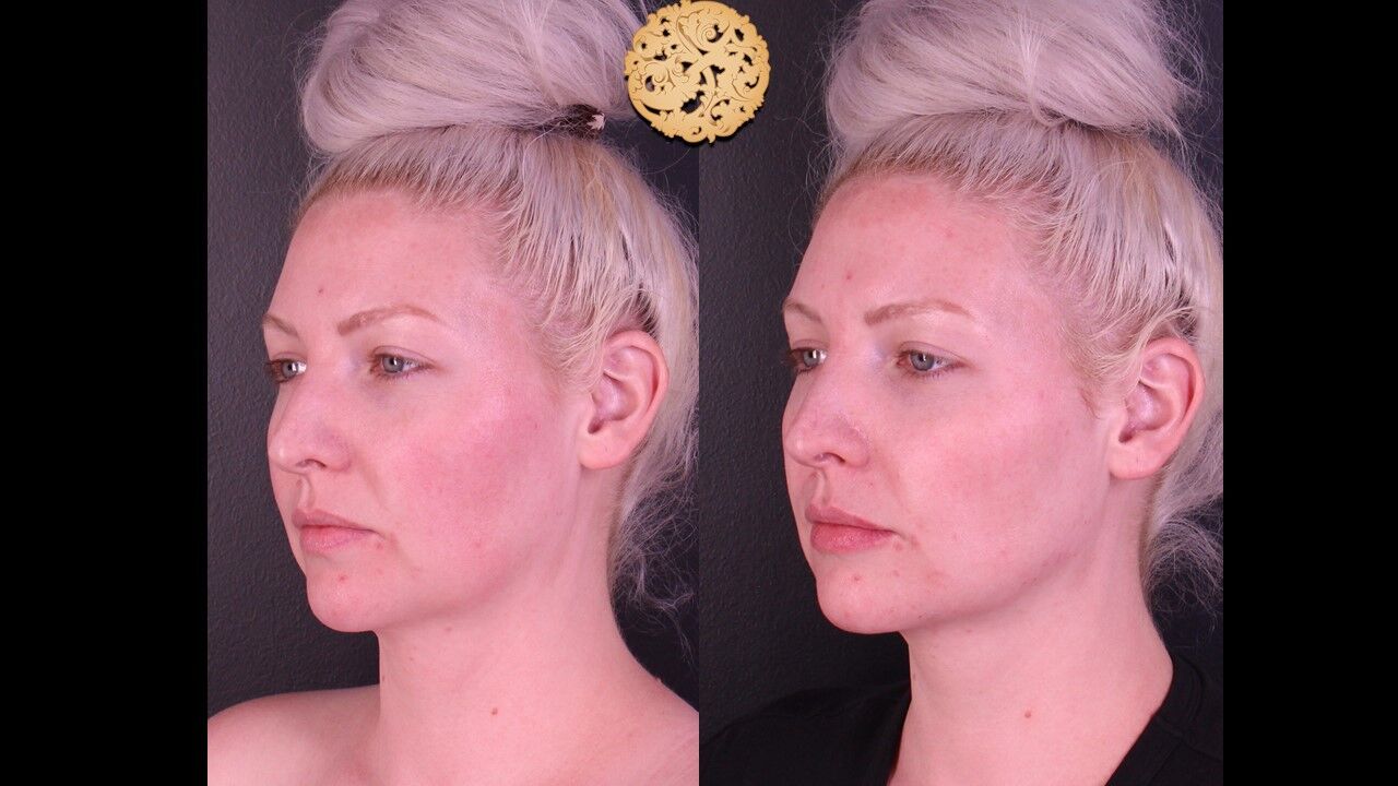 Jaw Filler Before & After