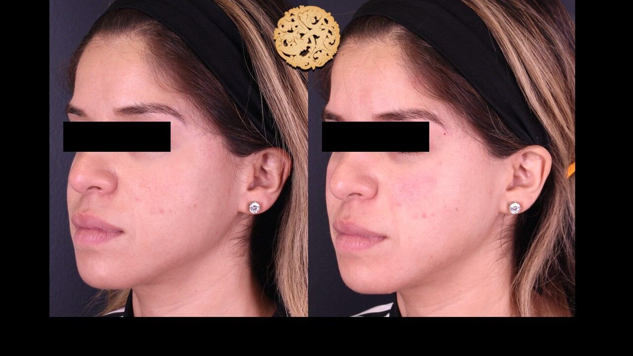 Jaw Filler Before & After