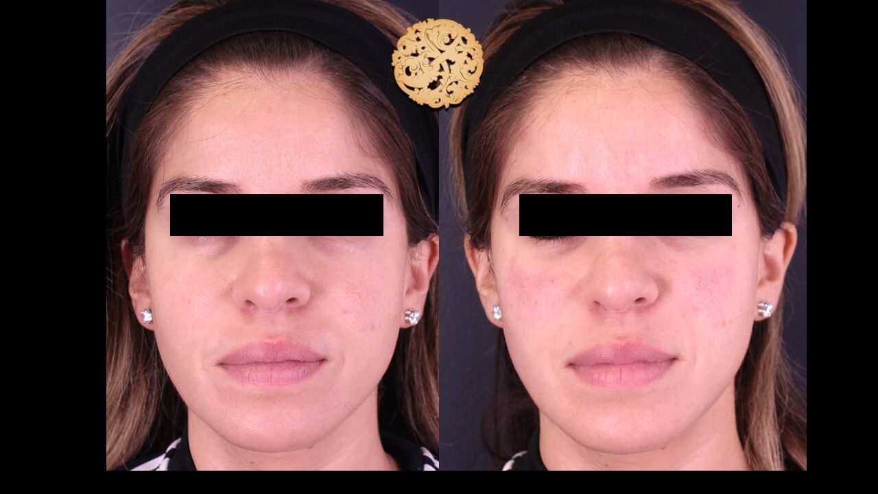 Jaw Filler Before & After