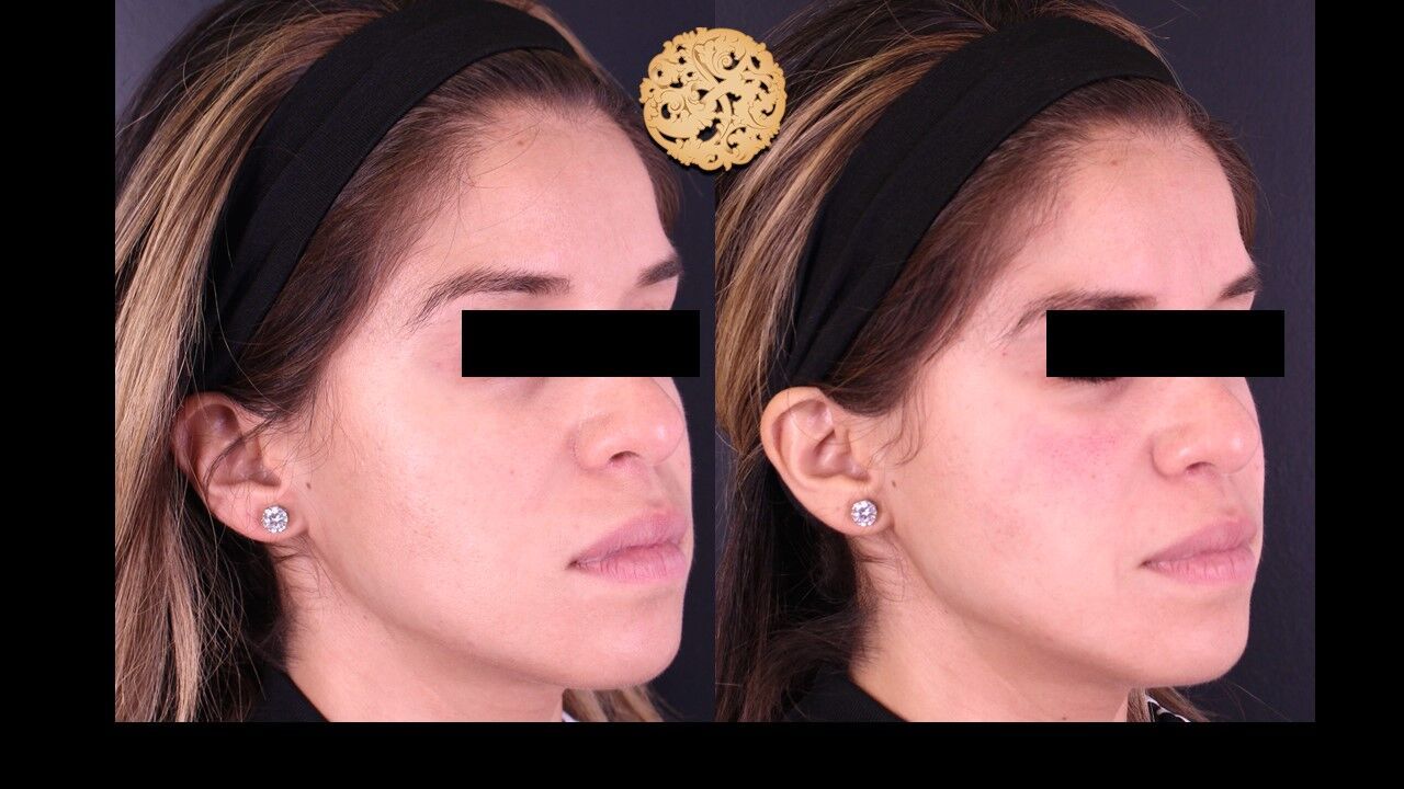 Jaw Filler Before & After