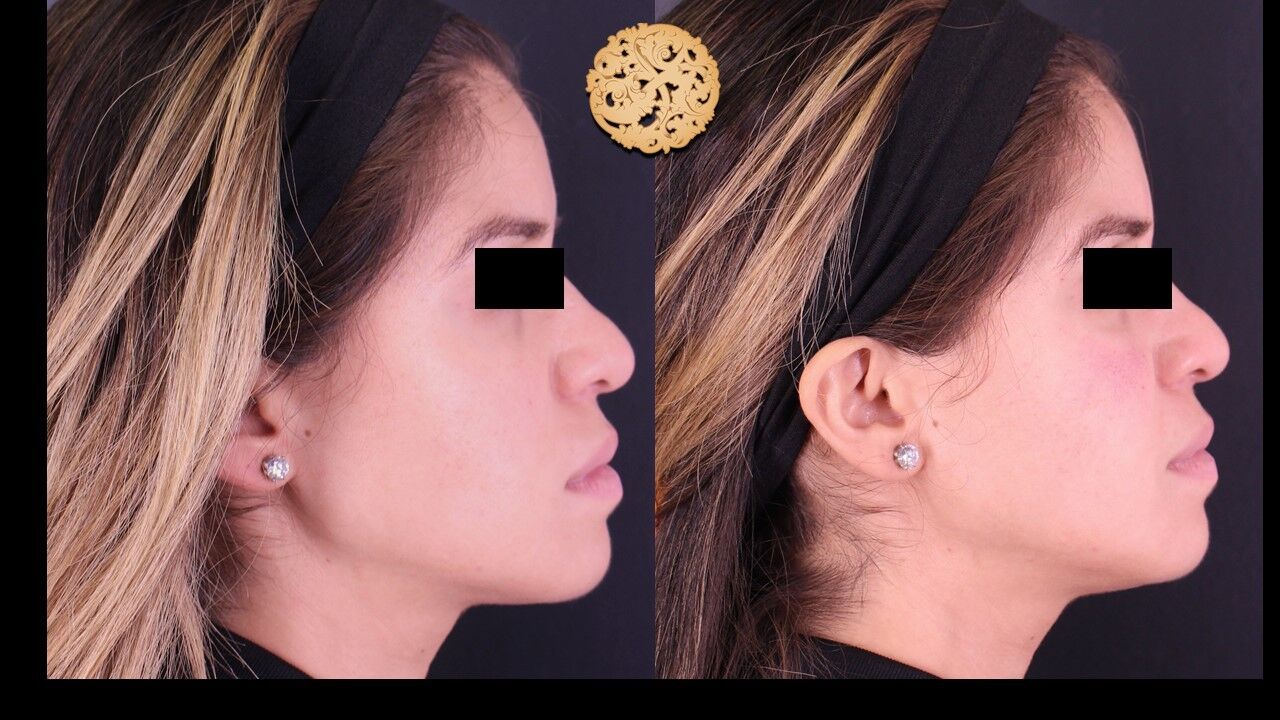 Jaw Filler Before & After