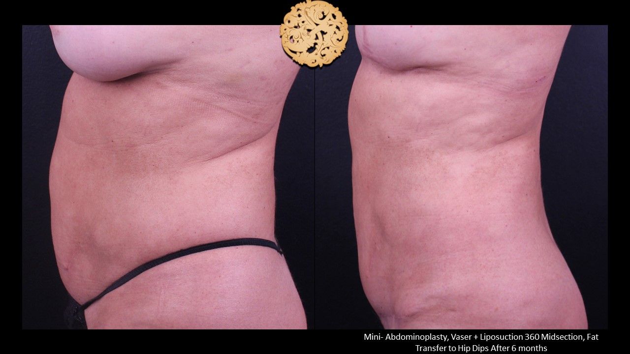Mini Tummy Tuck Before & After