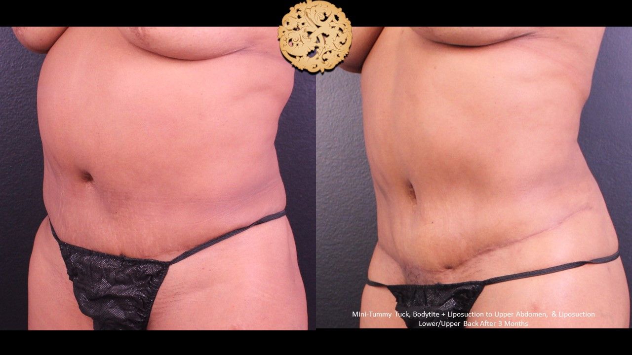Mini Tummy Tuck Before & After
