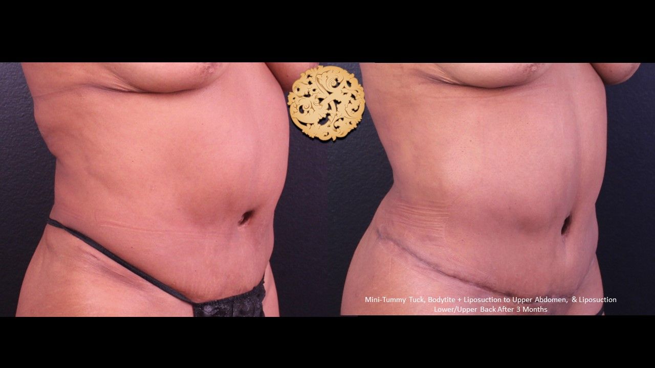 Mini Tummy Tuck Before & After