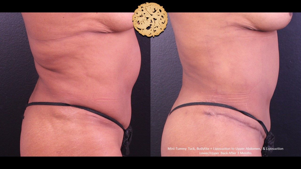 Mini Tummy Tuck Before & After