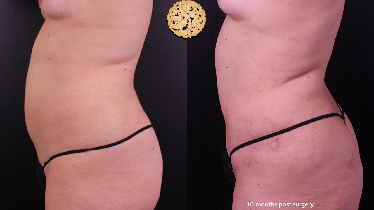 Mini Tummy Tuck Before & After