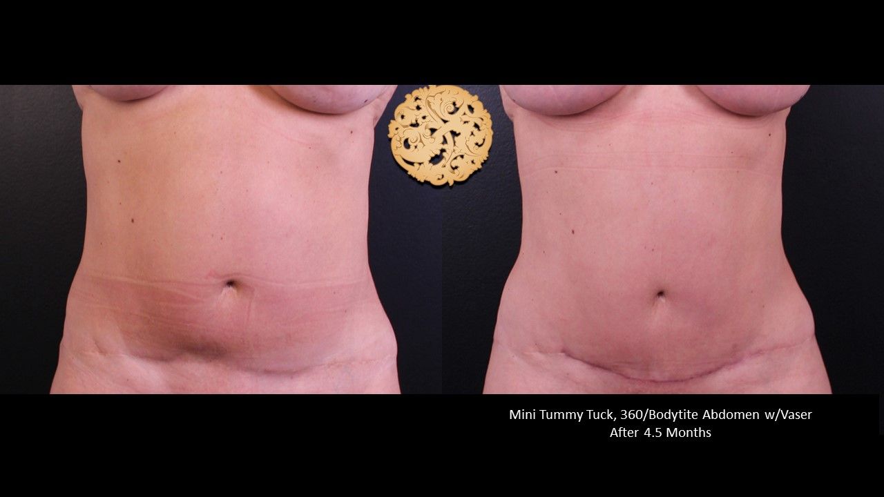 Mini Tummy Tuck Before & After
