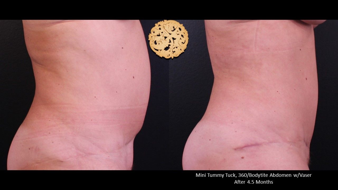 Mini Tummy Tuck Before & After