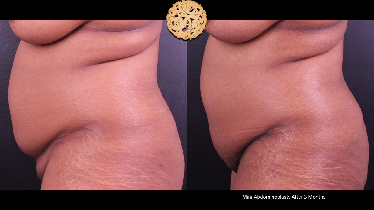 Mini Tummy Tuck Before & After
