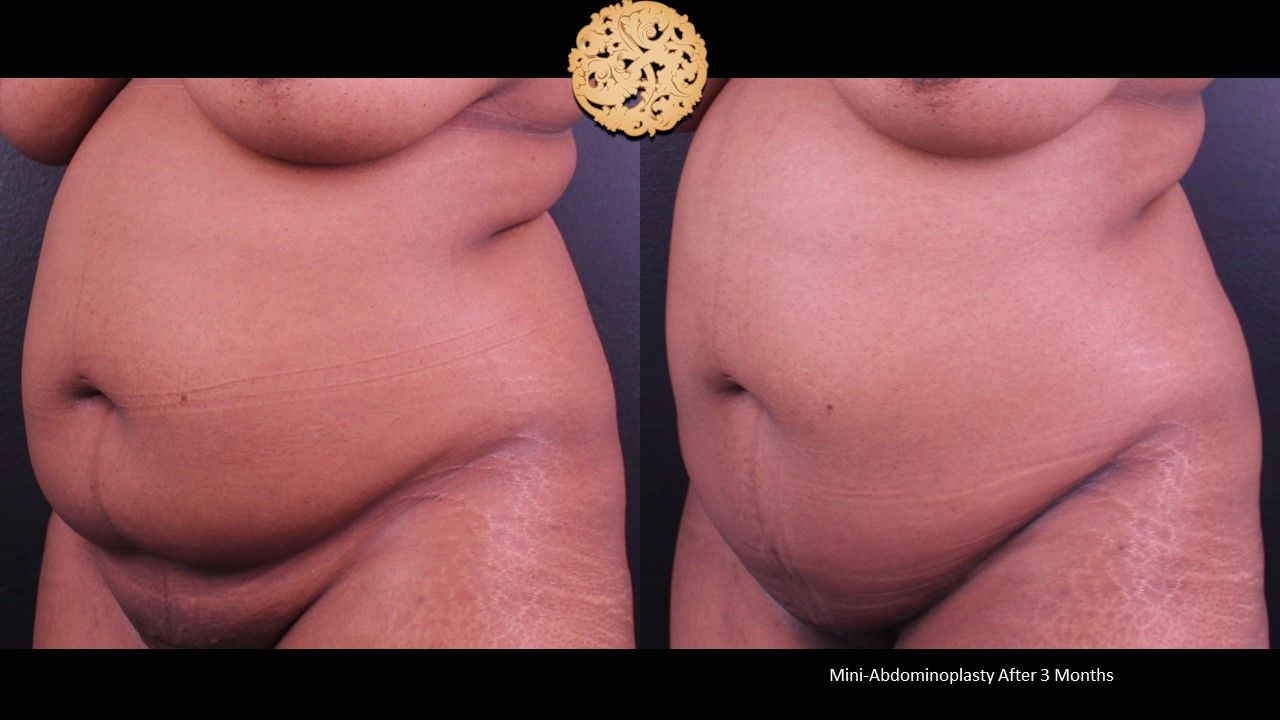 Mini Tummy Tuck Before & After