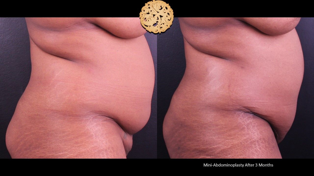Mini Tummy Tuck Before & After