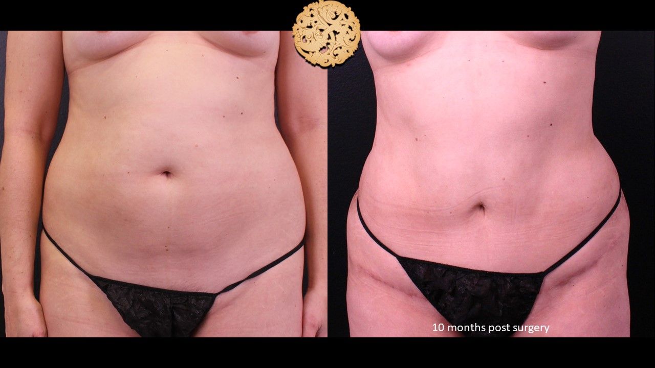 Mini Tummy Tuck Before & After