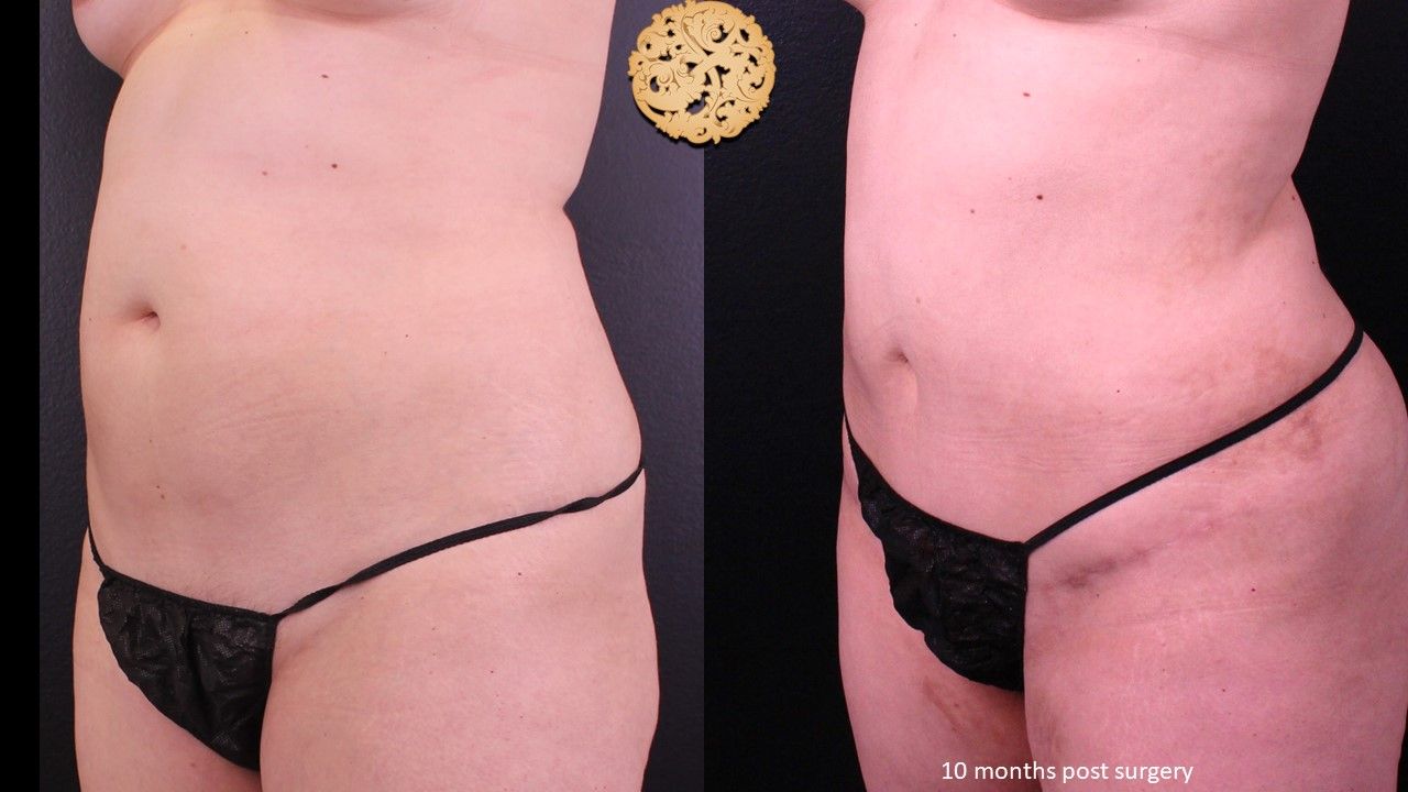 Mini Tummy Tuck Before & After