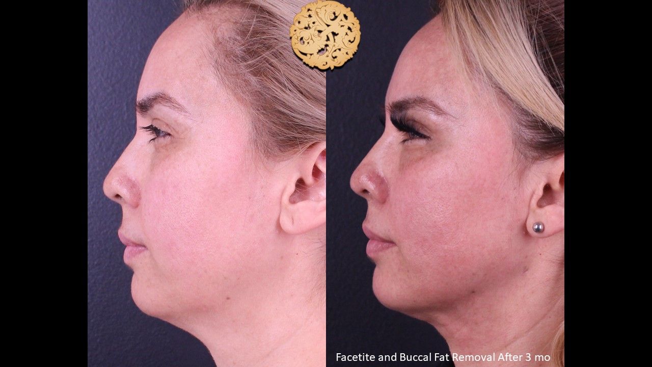Buccal Fat Removal Before & After